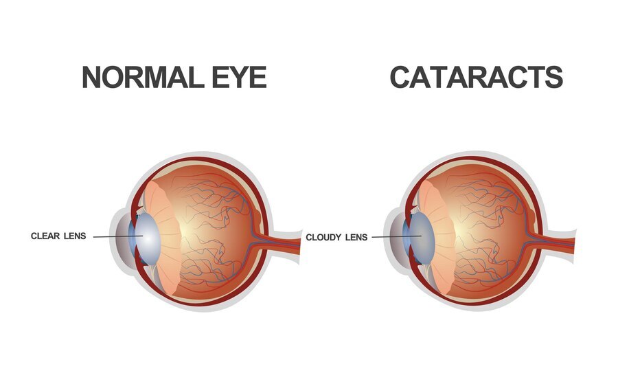 Cataract care services in begusarai (1)