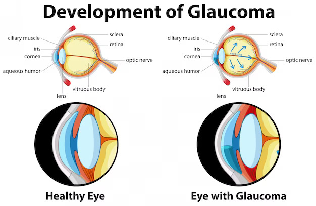 Glaucoma services in Begusarai